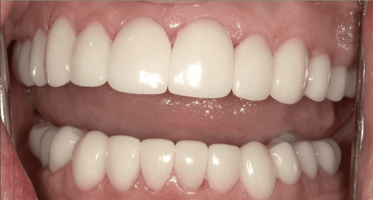 Scottsdale Cosmetic Dentistry smile makeover after — Scottsdale, AZ
