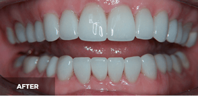 Scottsdale Cosmetic Dentistry smile makeover after — Scottsdale, AZ