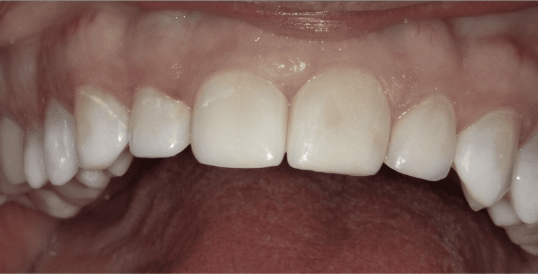 Scottsdale Cosmetic Dentistry smile makeover after — Scottsdale, AZ