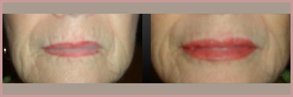Cosmetic Injectables by Lisa result — Fresno, CA