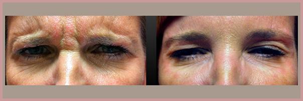 Cosmetic Injectables by Lisa botox result — Fresno, CA