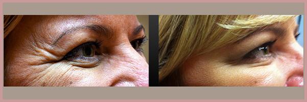 Botox result at Cosmetic Injectables by Lisa in Fresno, CA