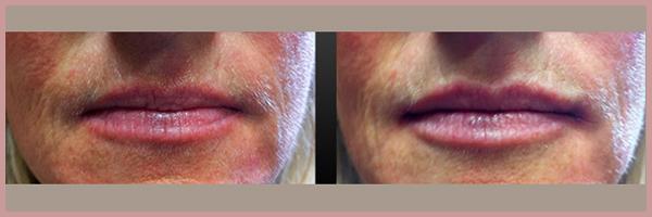 Cosmetic Injectables by Lisa result — Fresno, CA