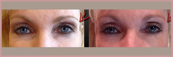 Cosmetic Injectables by Lisa result — Fresno, CA