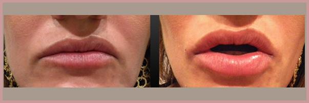 Cosmetic Injectables by Lisa result — Fresno, CA