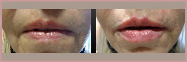 Cosmetic Injectables by Lisa result — Fresno, CA