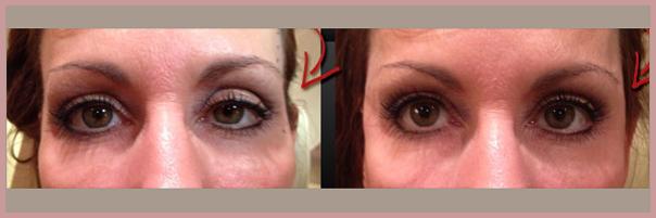 Cosmetic Injectables by Lisa result — Fresno, CA