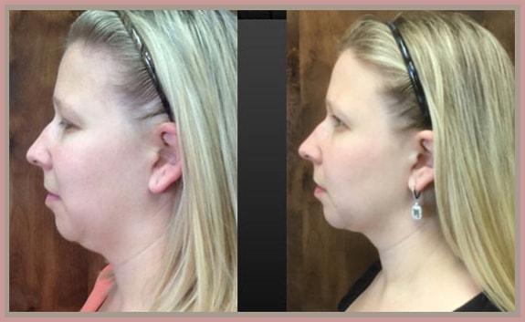 Cosmetic Injectables by Lisa double chin treatment result — Fresno, CA