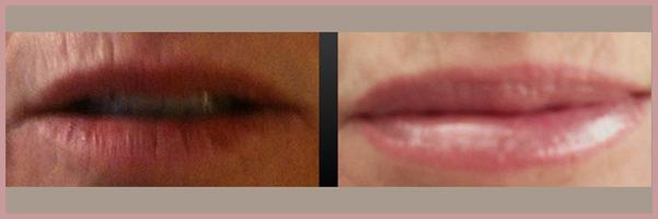 Cosmetic Injectables by Lisa result — Fresno, CA