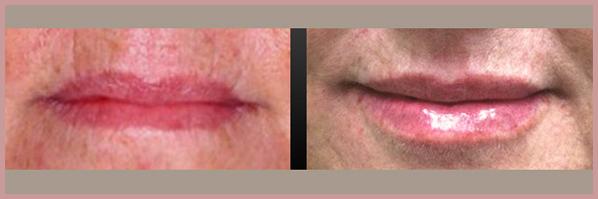 Cosmetic Injectables by Lisa result — Fresno, CA