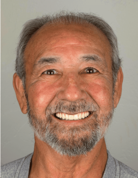 Hoopes Dental dental implants after — Ogden, UT