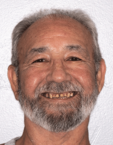 Dental Implants before at Hoopes Dental in Ogden, UT