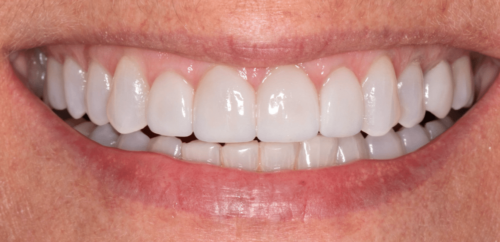 Hoopes Dental veneers after — Ogden, UT