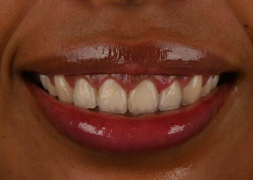 Botox after at Hoopes Dental in Ogden, UT