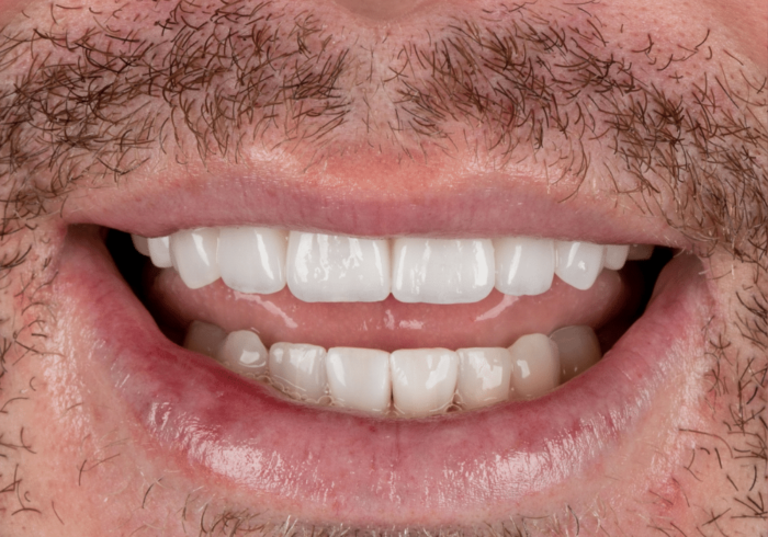 Hoopes Dental veneers after — Ogden, UT