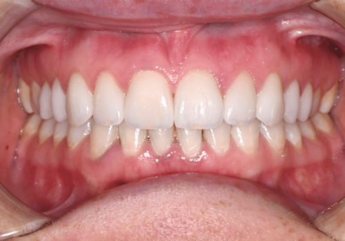 Hoopes Dental veneers after — Ogden, UT