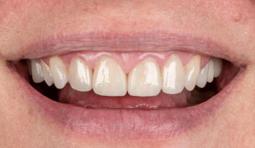 Hoopes Dental veneers after — Ogden, UT