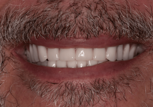 Hoopes Dental veneers after — Ogden, UT