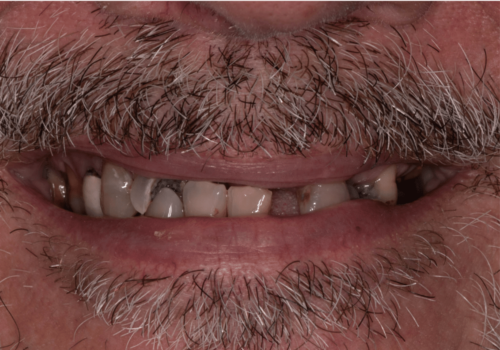 Dental Implants before at Hoopes Dental in Ogden, UT