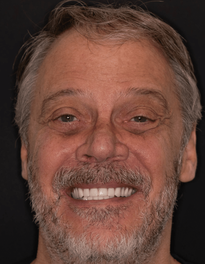 Hoopes Dental veneers after — Ogden, UT