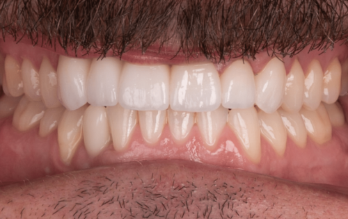 Hoopes Dental dental implants after — Ogden, UT