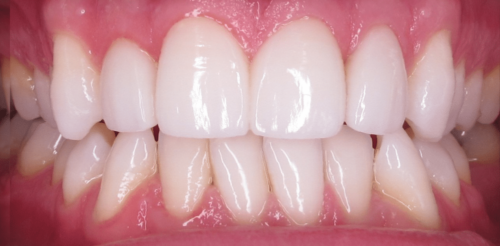Dental Veneers after at Hoopes Dental in Ogden, UT