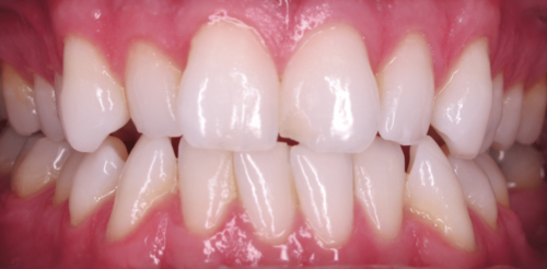 Dental Veneers before at Hoopes Dental in Ogden, UT