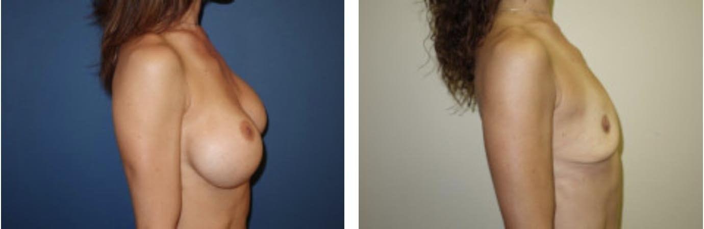 Davis Cosmetic Plastic Surgery breast implant removal result — Cherry Hill Township, NJ