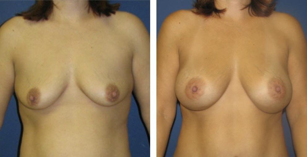 Davis Cosmetic Plastic Surgery breast augmentation result — Cherry Hill Township, NJ