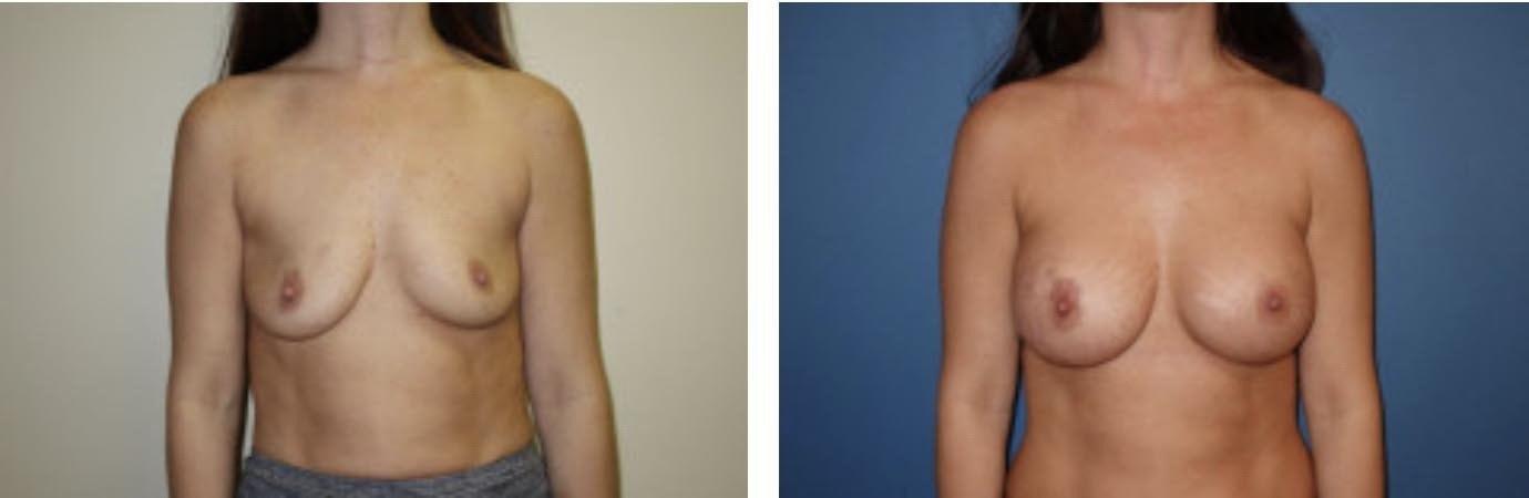 Davis Cosmetic Plastic Surgery breast augmentation result — Cherry Hill Township, NJ