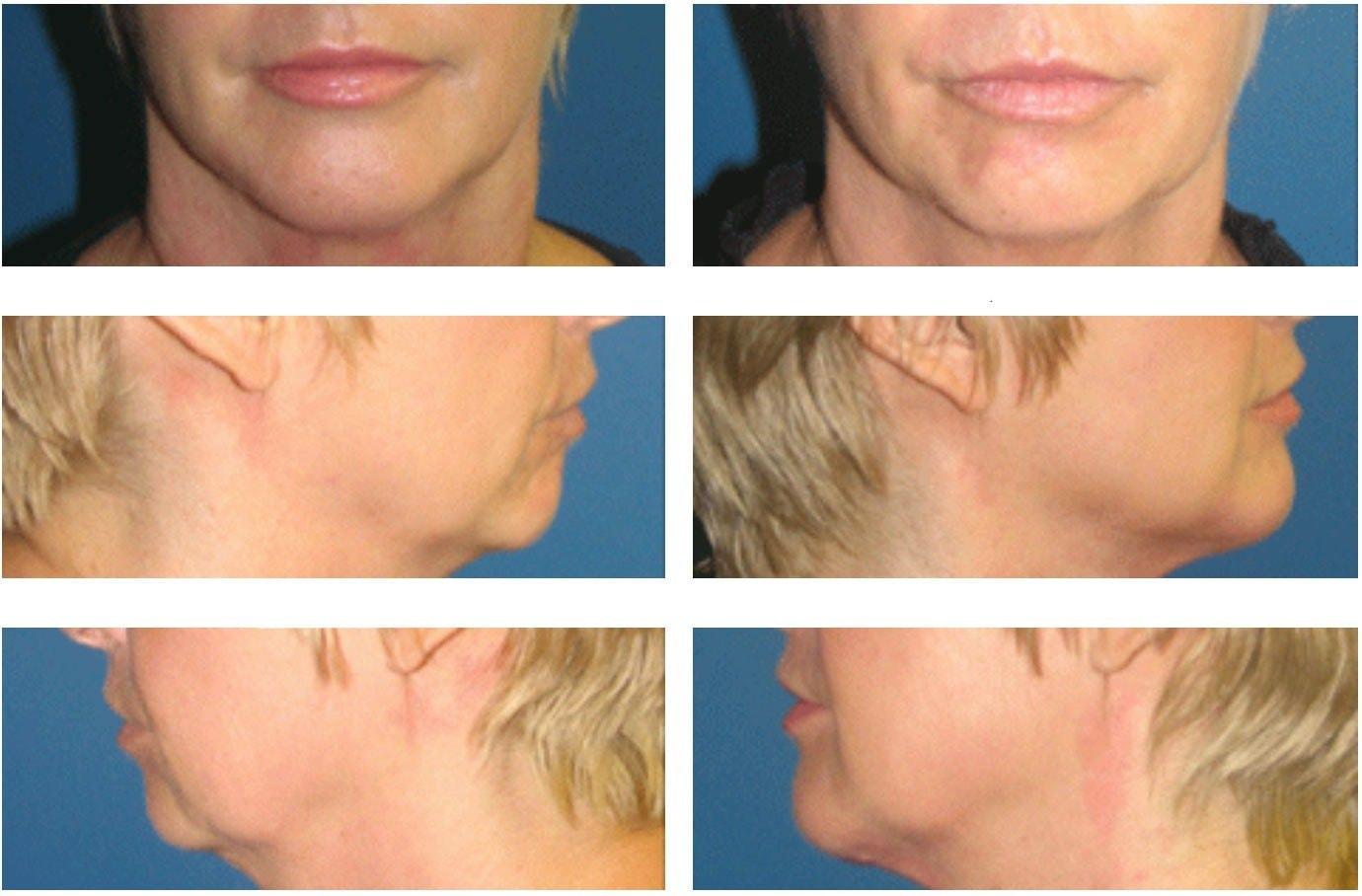 Davis Cosmetic Plastic Surgery chin implant result — Cherry Hill Township, NJ