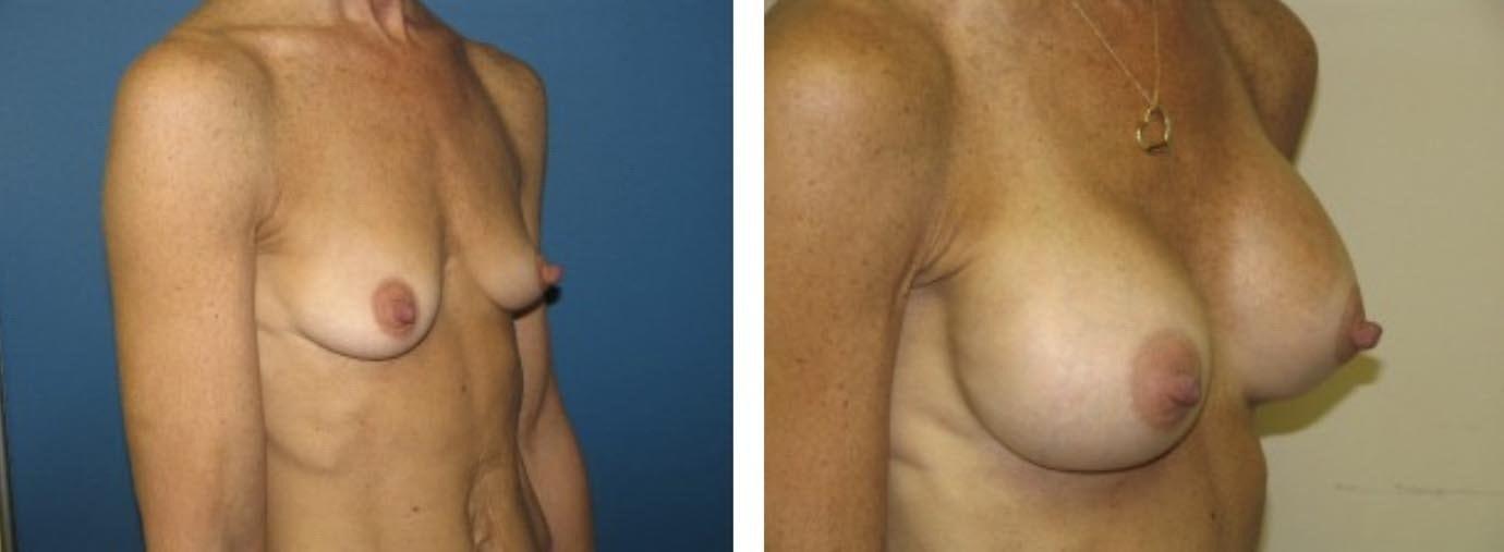 Davis Cosmetic Plastic Surgery breast augmentation result — Cherry Hill Township, NJ