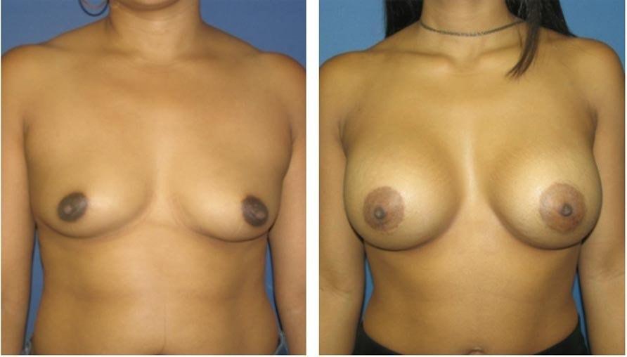Davis Cosmetic Plastic Surgery breast augmentation result — Cherry Hill Township, NJ
