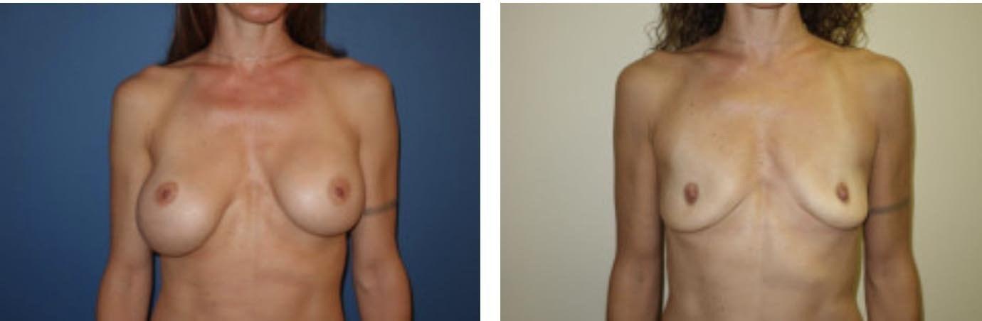 Davis Cosmetic Plastic Surgery breast implant removal result — Cherry Hill Township, NJ