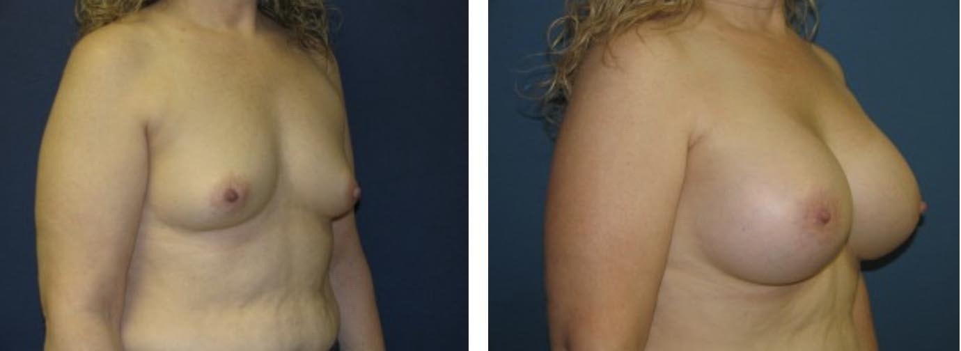 Davis Cosmetic Plastic Surgery breast augmentation result — Cherry Hill Township, NJ