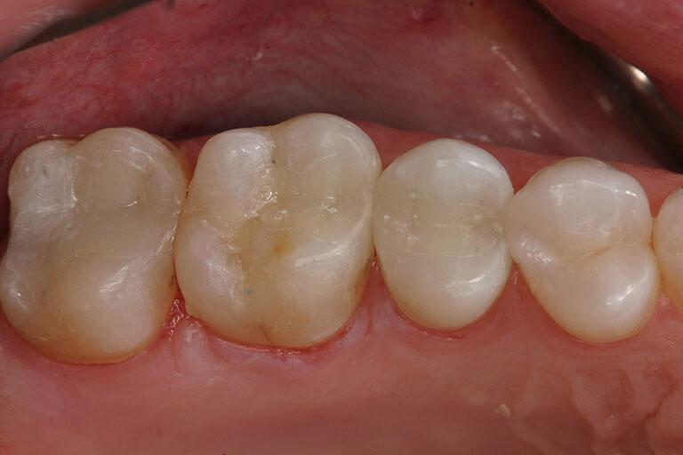 McDonald & Luck DDS smile makeover after — Plano, TX