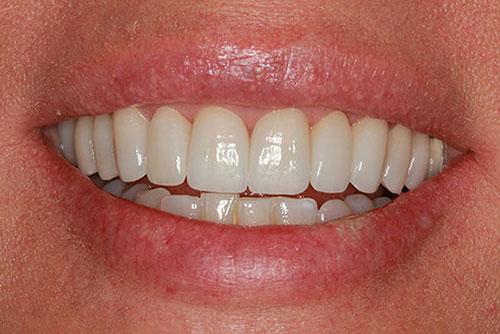 Smile Makeover after at McDonald & Luck DDS in Plano, TX