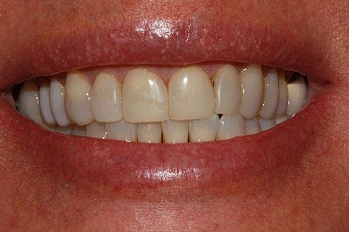 Smile Makeover before at McDonald & Luck DDS in Plano, TX