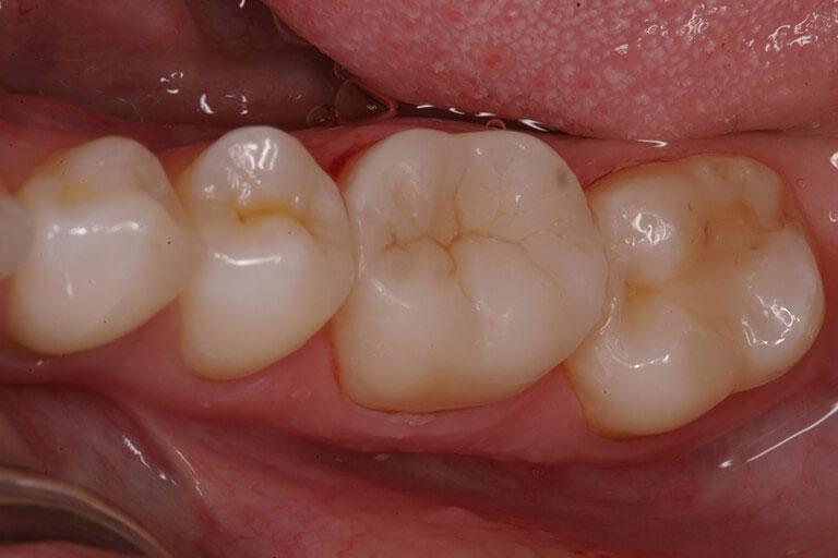 McDonald & Luck DDS smile makeover after — Plano, TX