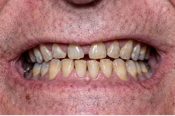 Dental Veneers before at McDonald & Luck DDS in Plano, TX
