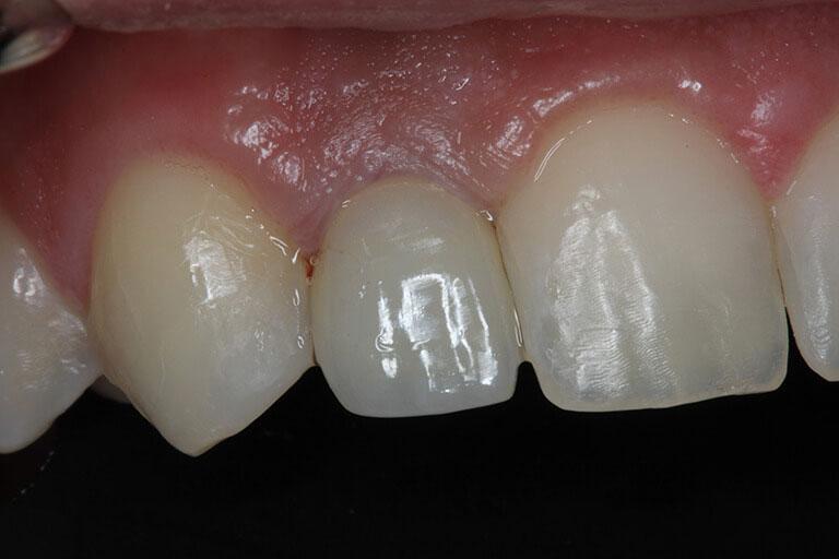 McDonald & Luck DDS smile makeover after — Plano, TX