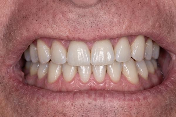 Dental Veneers after at McDonald & Luck DDS in Plano, TX