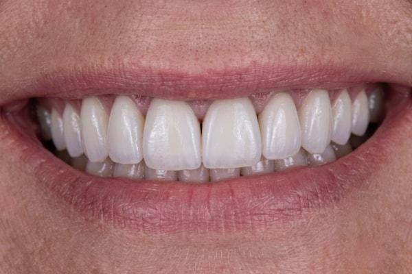 Dental Veneers after at McDonald & Luck DDS in Plano, TX
