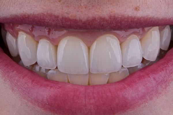 McDonald & Luck DDS smile makeover after — Plano, TX