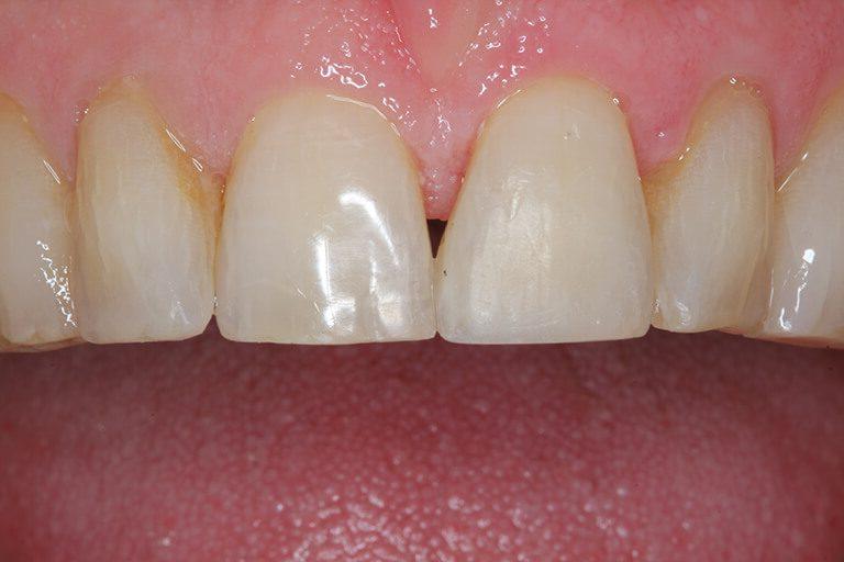 McDonald & Luck DDS smile makeover after — Plano, TX