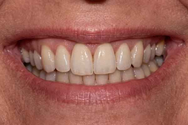 Dental Veneers before at McDonald & Luck DDS in Plano, TX