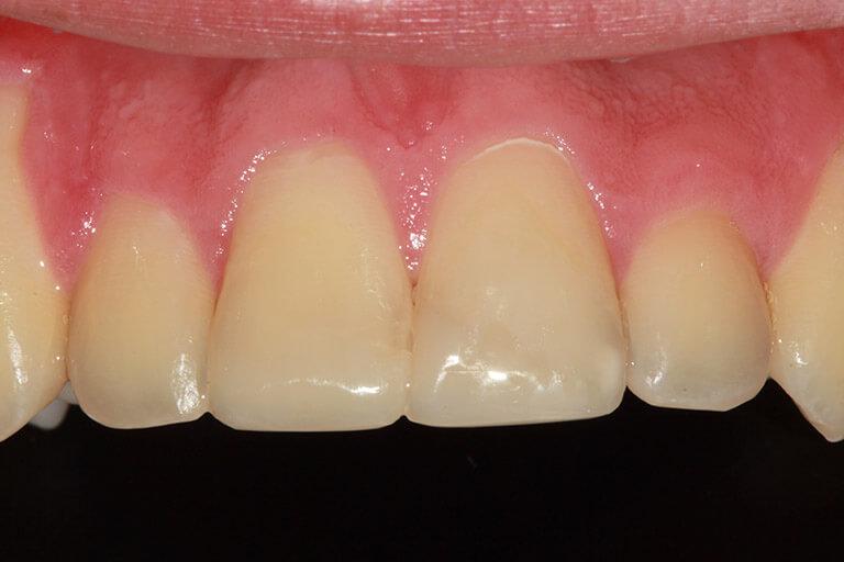 McDonald & Luck DDS smile makeover after — Plano, TX