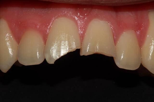 Smile Makeover before at McDonald & Luck DDS in Plano, TX