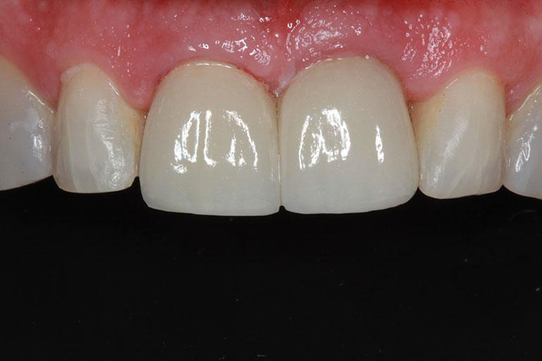McDonald & Luck DDS smile makeover after — Plano, TX