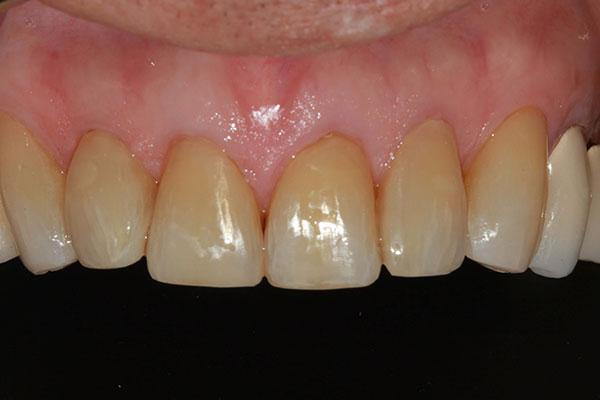 Smile Makeover after at McDonald & Luck DDS in Plano, TX